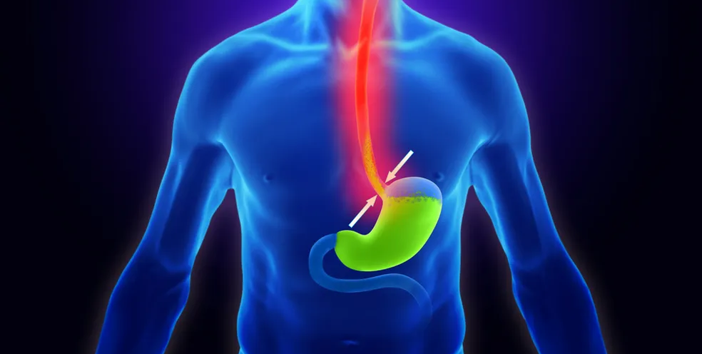 Doença do Refluxo - Dr. Leonardo Vieira
